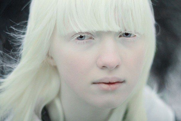 mezhdunarodnyj-den-rasprostraneniya-informatsii-ob-albinizme